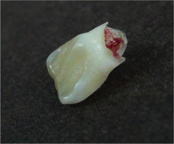 儿童换牙什么时候能换好,儿童换牙时间一般在几岁左右开始