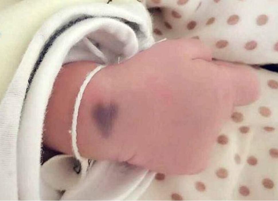 婴儿身上像有淤青一样的怎么回事,小婴儿身上有淤青是什么原因