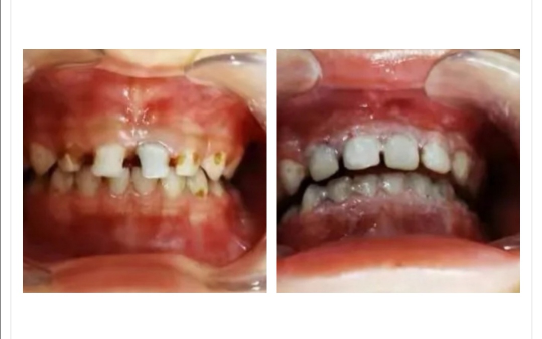 四岁小孩20颗牙坏14颗是什么概念,11岁的孩子牙坏了11颗是怎么回事