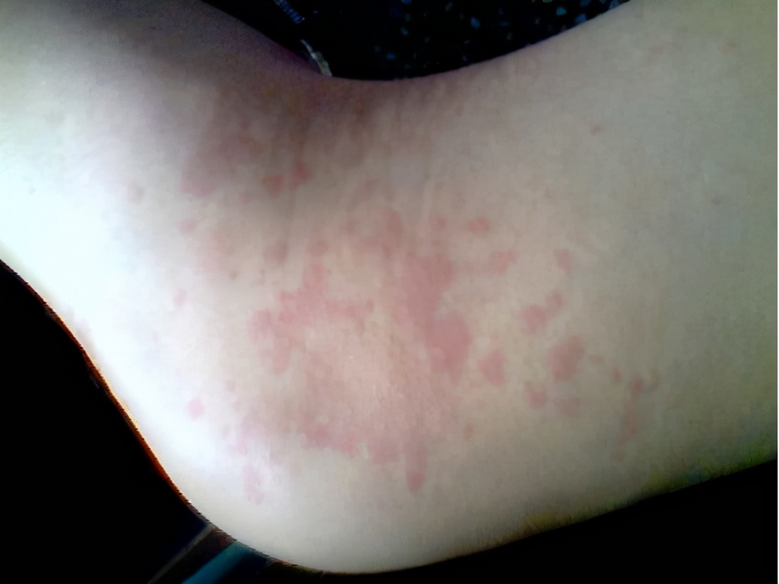 荨麻疹缓解瘙痒的方法是什么,荨麻疹瘙痒难忍可以用什么缓解