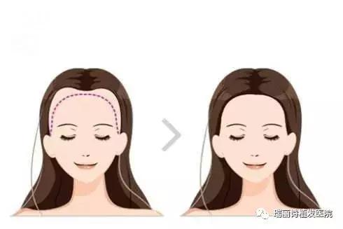 自体植发怎么移植,自体同源细胞移植植发