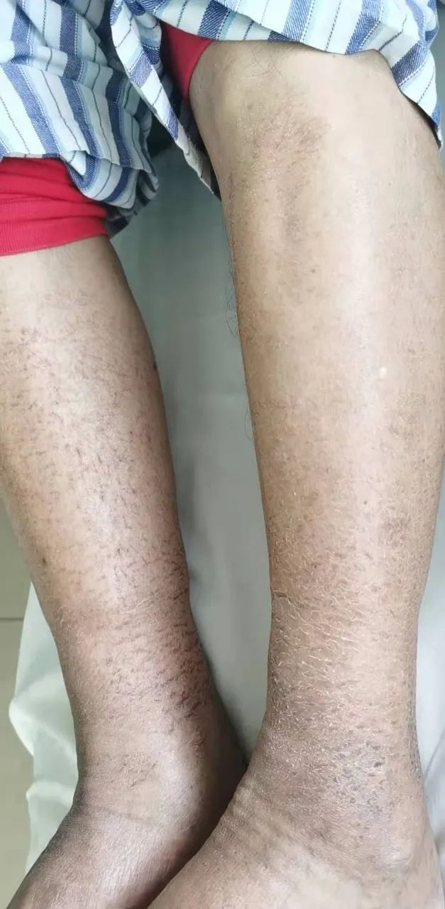 冬季干燥皮肤瘙痒症的治疗方法,冬季下肢皮肤干燥瘙痒用什么药