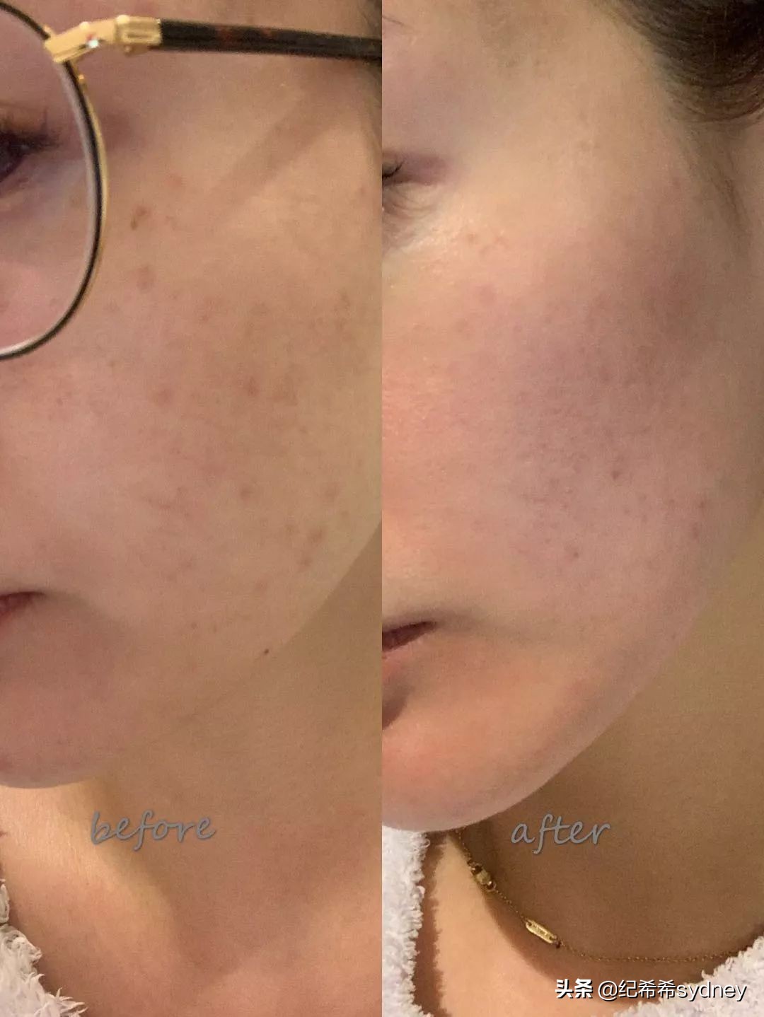 皮秒真实测评,皮秒收缩毛孔测评