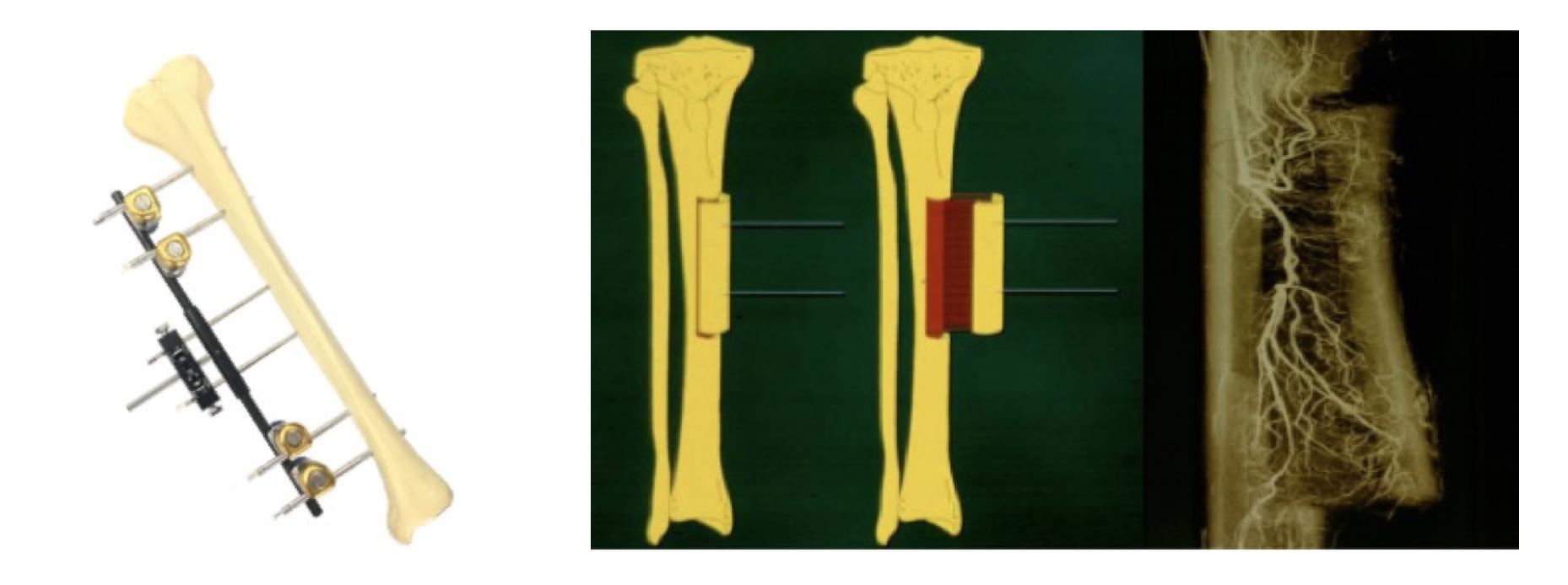 糖尿病足截肢后怎么长肉快,糖尿病足不截肢的最新疗法