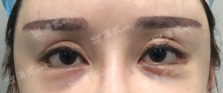 做外眼角改变到底大不大,开外眼角的手术后的图片
