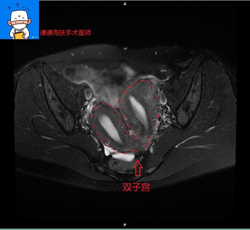 子宫内膜肌瘤鉴别诊断,子宫肌瘤的鉴别诊断以及鉴别要点