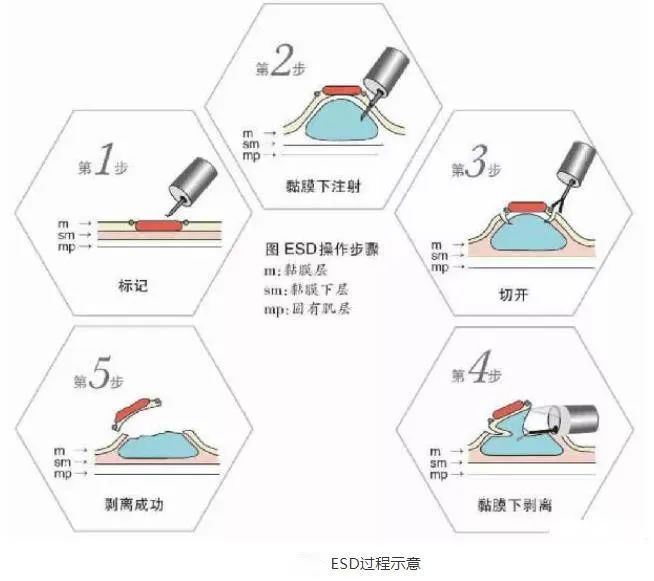 消化道早癌筛查镇江,内镜下消化道早癌的治疗前景