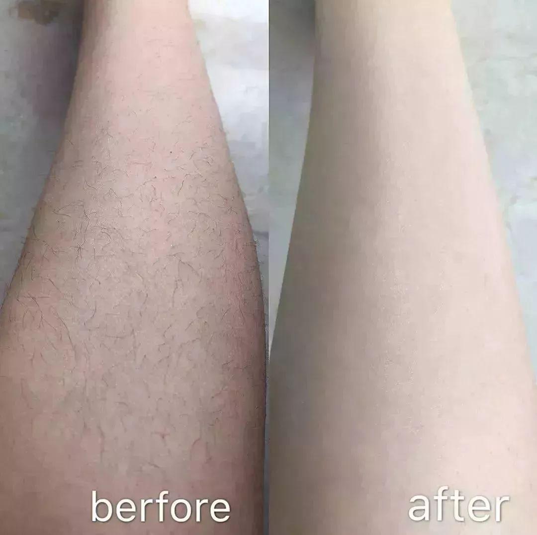 强烈推荐，永久脱毛，好评超多，拿走不谢