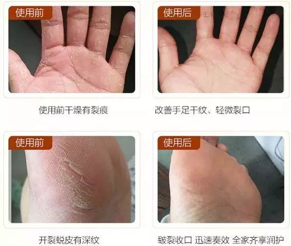 手脚干裂皮肤又厚又痒怎么办,冬天手脚干裂起皮怎么治疗