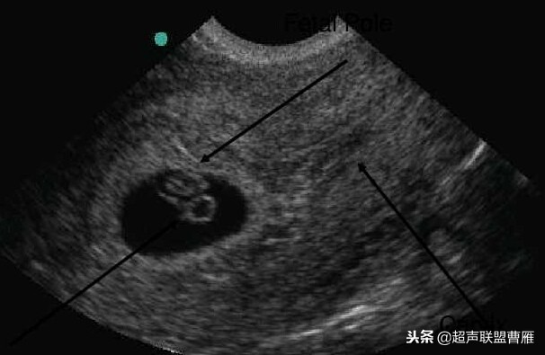 3毫米卵黄囊未见胎芽正常么,40多天的卵黄囊
