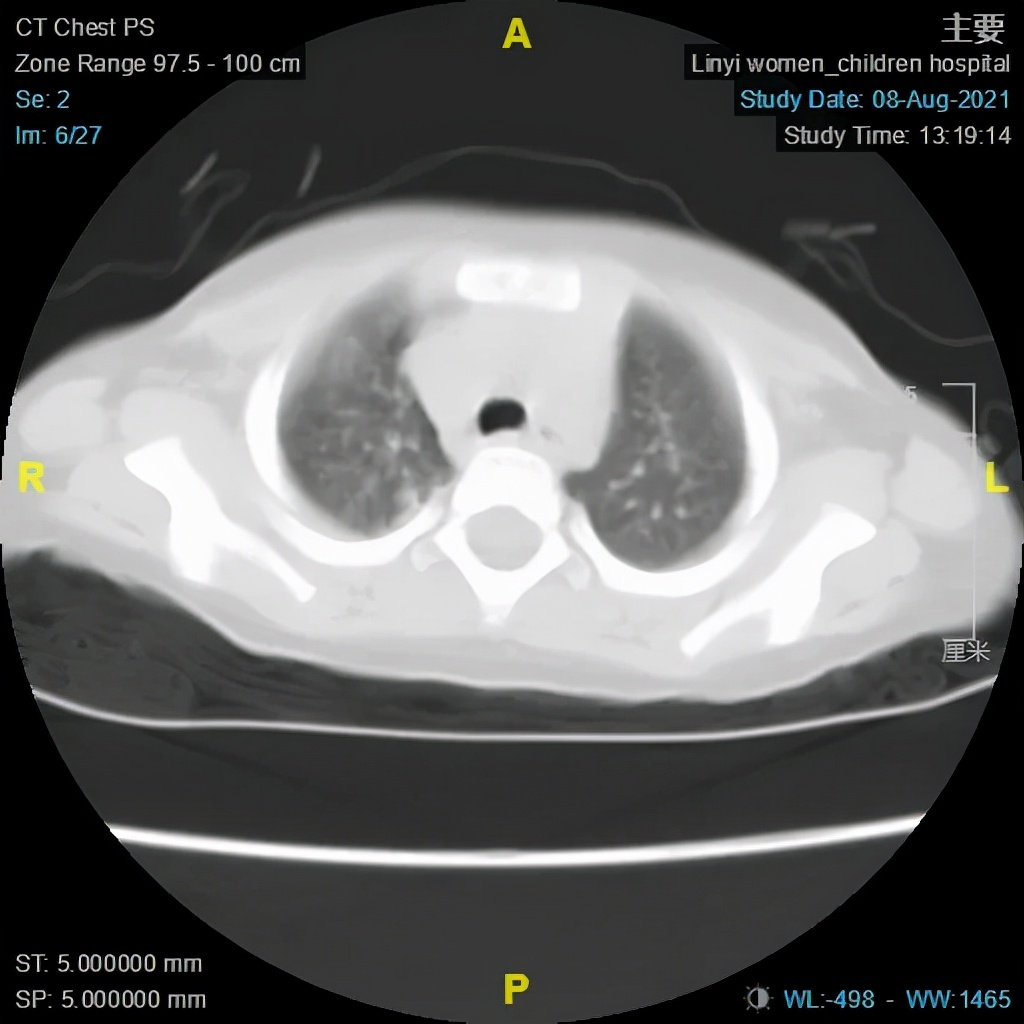 小孩肺炎支气管镜洗肺过程,肺炎总是不好怎么办