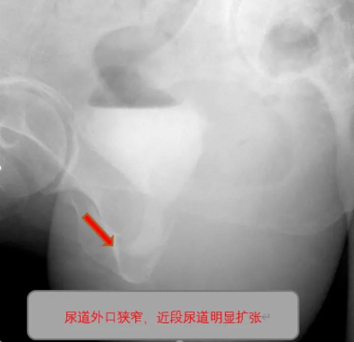 广场舞跟不上节奏，咳嗽、大笑就会“尿裤子”，56岁杭州女子苦不堪言！专家：可治愈，别耽误