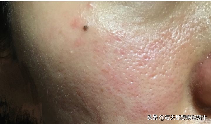 脸干长痘毛孔粗红血丝用什么修复,脸部泛红毛孔大怎么改善