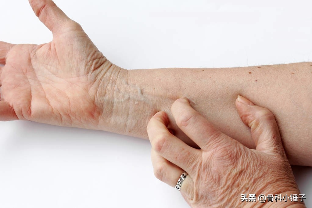 绁炵粡鎬х毊鐐庣殑鏈夋晥娌荤枟鏂规硶,绁炵粡鎬х毊鐐庣殑鏈夋晥鍋忔柟