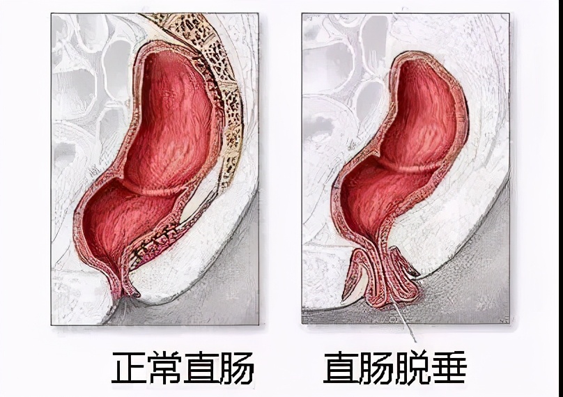 治脱肛去肛肠医院还是去县医院,北京东大肛肠医院治便秘吗
