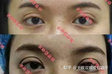 可以只开眼角不割双眼皮吗,双眼皮到底要不要开眼角