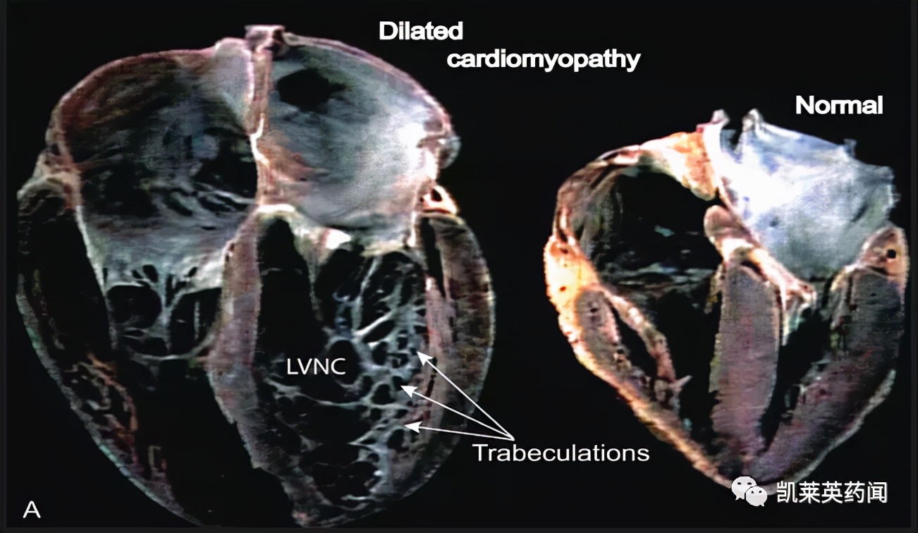 新药巡礼：修复线粒体异常，超罕见病迎来治疗曙光