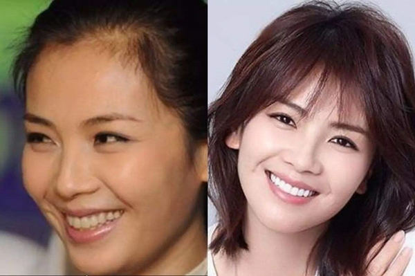 刘涛花了多少钱做牙齿,刘涛整牙花了多少钱