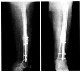骨科髓内钉器械图谱,小儿骨科髓内钉取出术过程