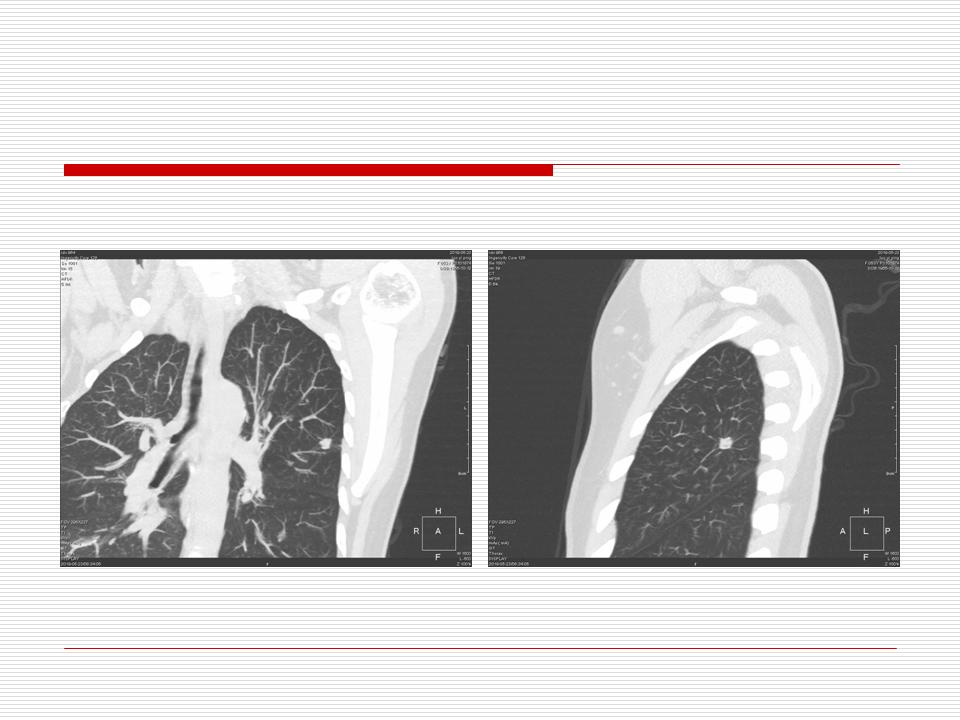 像炎症的肺癌能治好吗,医生说可能是肺癌也可能是炎症