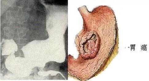 胃癌超过5年的真实案例,2021全球胃癌数据