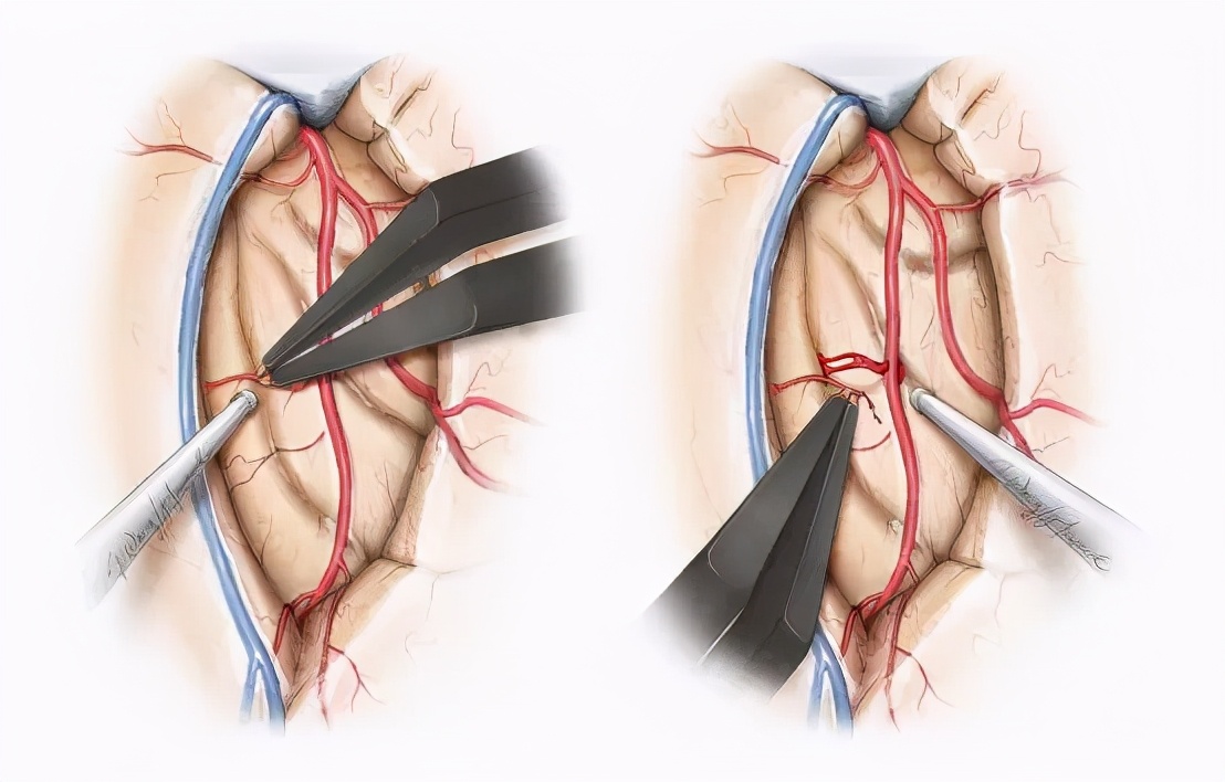 岛叶胶质瘤手术是开颅还是微创,岛叶良性胶质瘤复发率