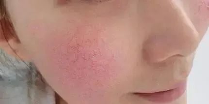 脸过敏干燥起皮紧绷发红怎么修复,换季皮肤过敏起皮用什么药