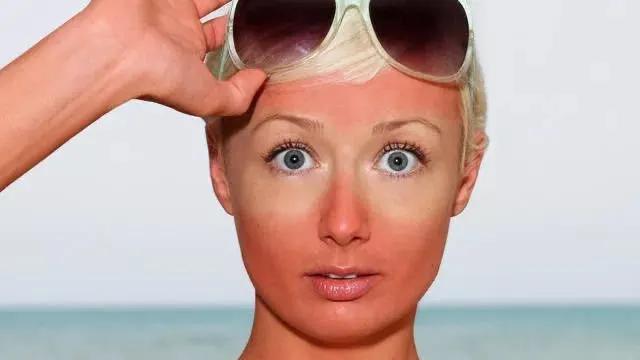 晒黑晒伤怎么快速恢复,晒伤晒黑最快美白修复方法面霜