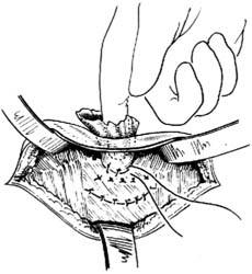 大猪脐疝怎么解决,猪脐疝防治方法