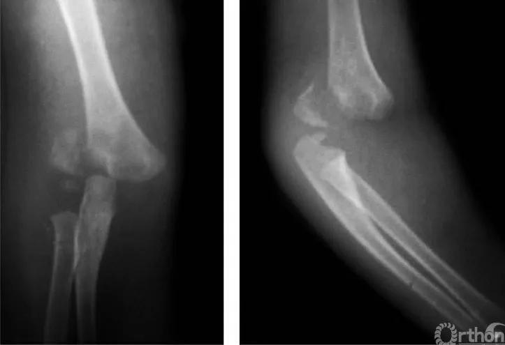 左肱骨外髁骨折并骨骺分离,肱骨远端全骨骺分离怎么检查