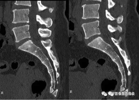 骶骨摔伤怎么判断是不是骨折,骶尾椎骨骨折最佳治疗方法