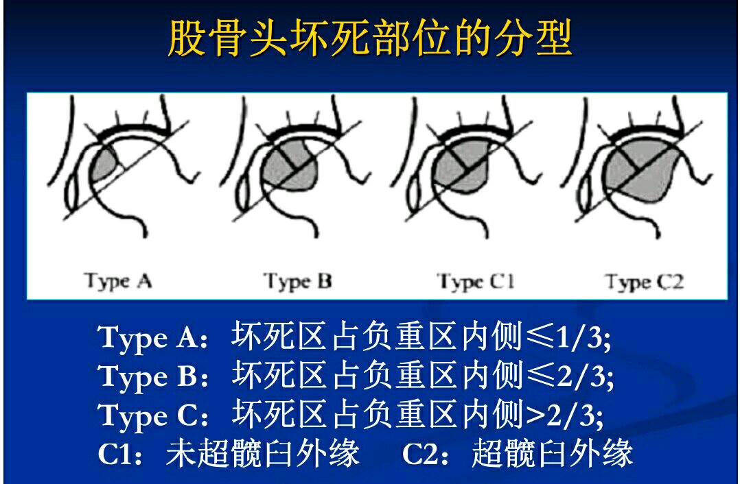 股骨头坏死心理治疗,髋关节坏死晚期心态