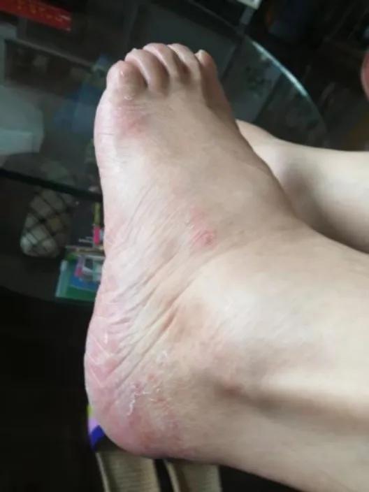 角质去除小妙招,角质层真菌怎么消除最快