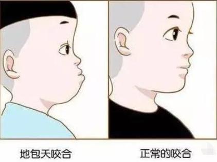 地包天什么时候开始矫治,地包天为什么要尽早矫治