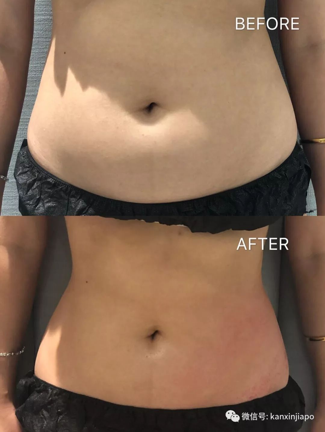 额头长闭口毛孔粗大爆痘怎么办,皮肤爆痘起闭口怎么回事