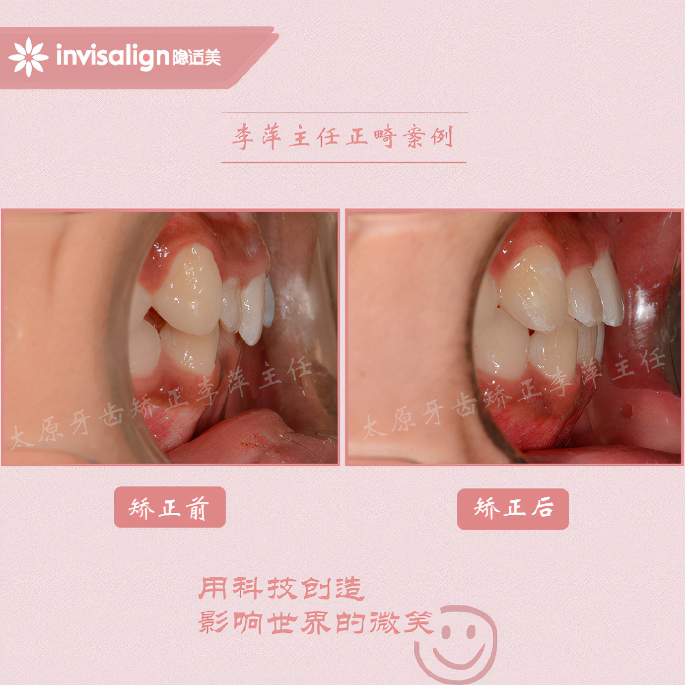 山西太原牙齿矫正医院十大排名,太原市牙齿矫正成功案