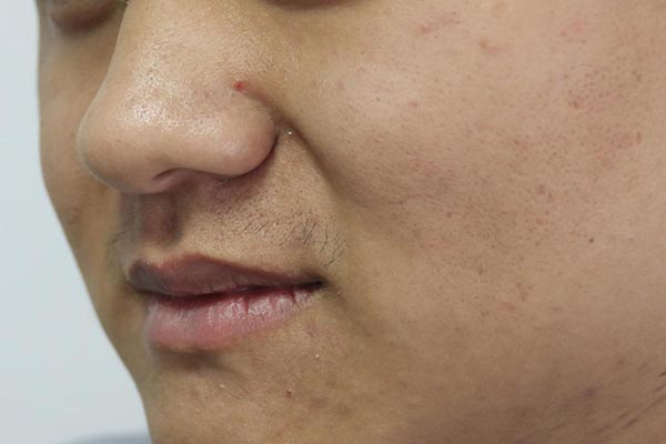 女孩油皮换季脸部起皮泛红,脸部干燥起皮屑是什么原因