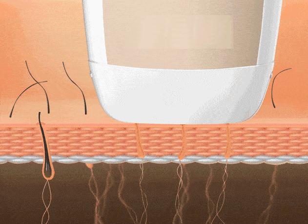 脱毛最有效方法,女生怎么脱毛副作用最小