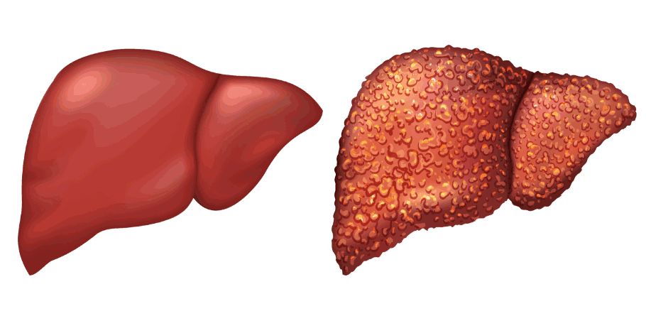 干细胞移植可以治疗肝硬化肝腹水,干细胞移植治疗肝硬化最新进展