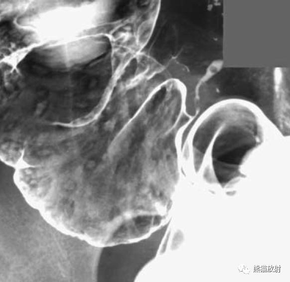 腹部影像图片大全,乙状直肠疼痛位置图片