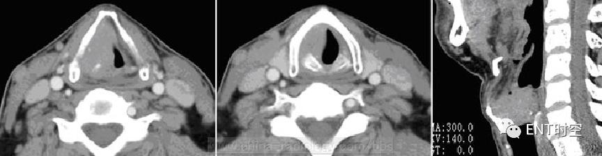 主任读片会：六大「喉部典型病例」大饱眼福
