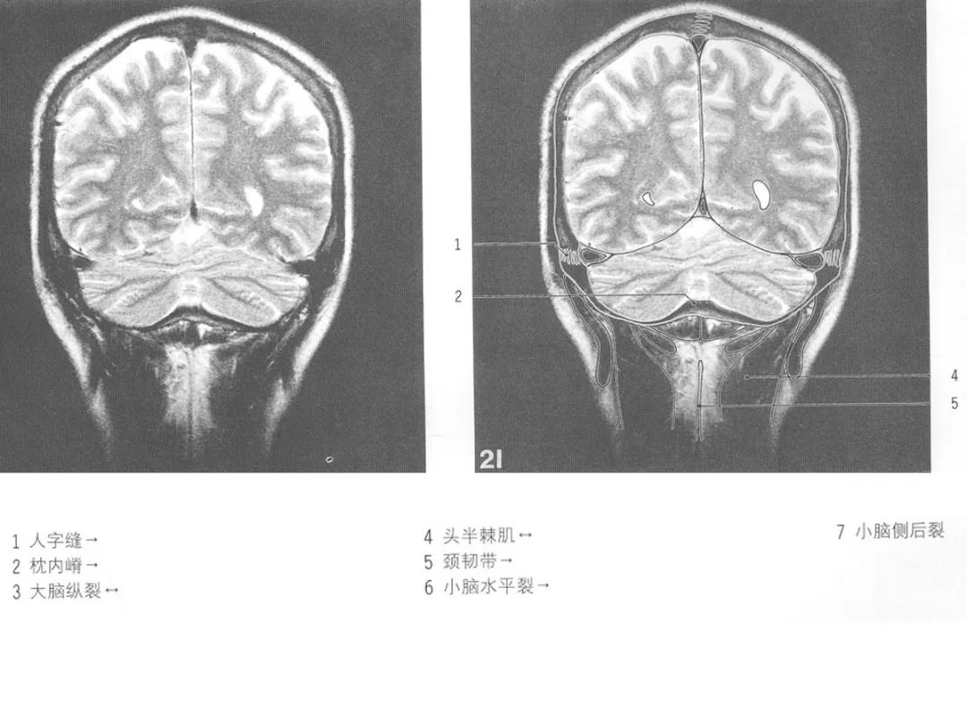 颅脑冠状状切面解剖图,颅脑mr解剖结构图