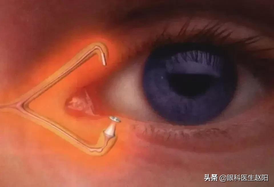 缓解干眼的眼药水,缓解干眼症最有效的眼药水