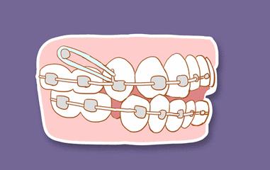 矫正牙齿很难受是怎么坚持下来的,矫正牙齿的过来人的忠告