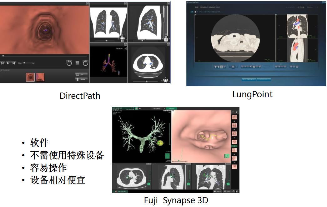 孙加源门诊,治疗肺癌的新技术新手段