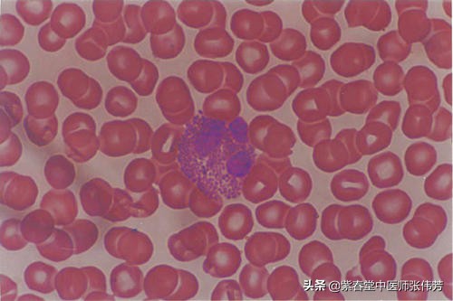 过敏性紫癜红点多长时间可以消退,过敏性紫癜红点消退后还需要忌口