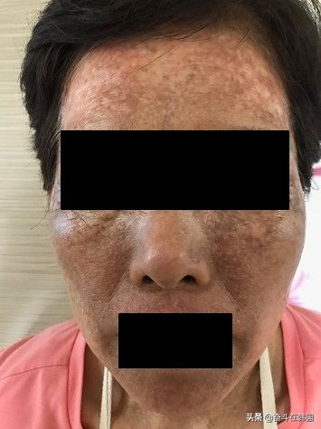 太惨了!这起染发*案惨**在韩国又双叒发生了