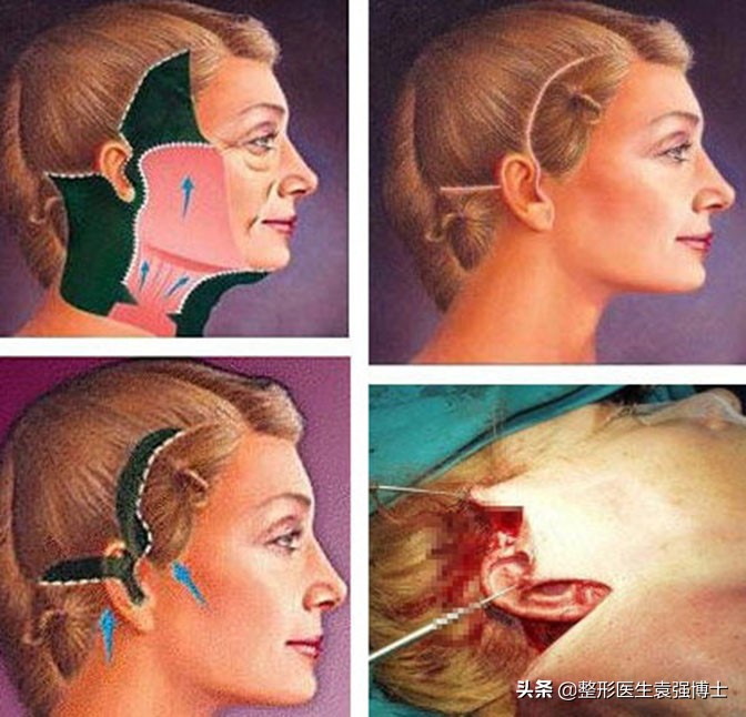 整形医院消除法令纹,医生消除法令纹