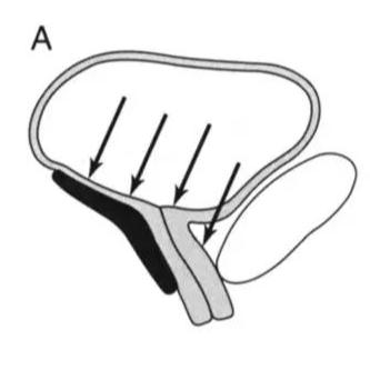 生完孩子盆底恢复不好会漏尿吗,盆底康复治疗漏尿有效果吗