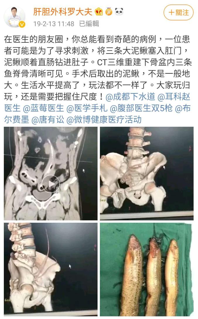 一条罗非鱼“游”进肛门?医生:直肠不直,进去容易出来难